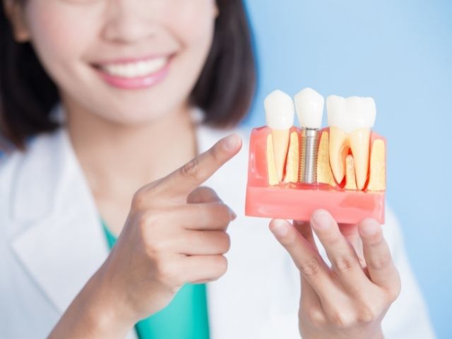 Read more about the article Impianto dentale: gli errori da evitare per le cure dentali