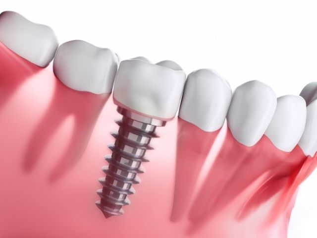 Read more about the article Impianto Dentale: Ecco Cos’é e Come Funziona