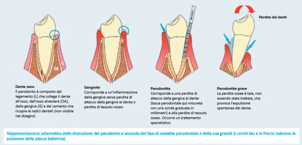 parodontite-dental-turk